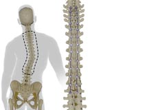 Adult Scoliosis Correction