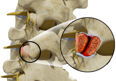 Spinal Compression Fracture Chicago, IL  Spine Osteoporosis Schaumburg,  Crystal Lake