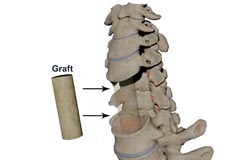 Spinal Compression Fracture Chicago, IL  Spine Osteoporosis Schaumburg,  Crystal Lake