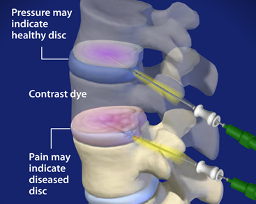 Discogram Chicago, IL | Back Pain Schaumburg | Facet Syndrome Crystal Lake